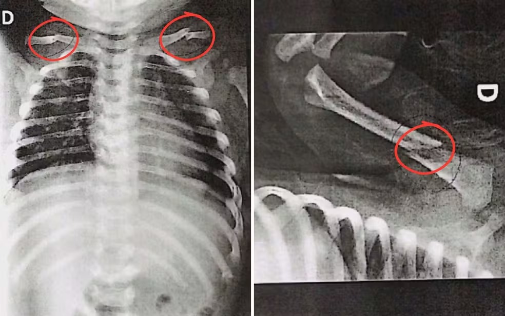 Bebê com múltiplas fraturas é levada a hospital; pai é preso — Foto: Reprodução/TV Anhanguera