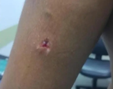 Braço do PM que foi mordido - (Foto: reprodução/PM)